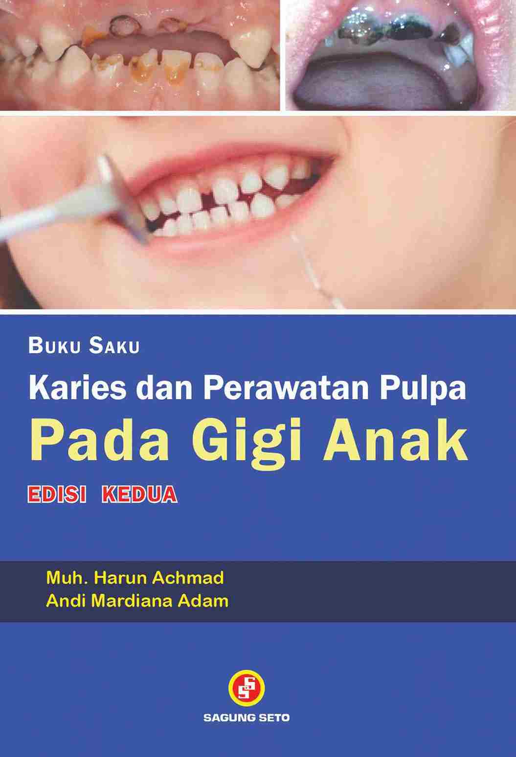 Cover BUKU SAKU KARIES DAN PERAWATAN PULPA PADA GIGI ANAK / Muh. Harun Achmad